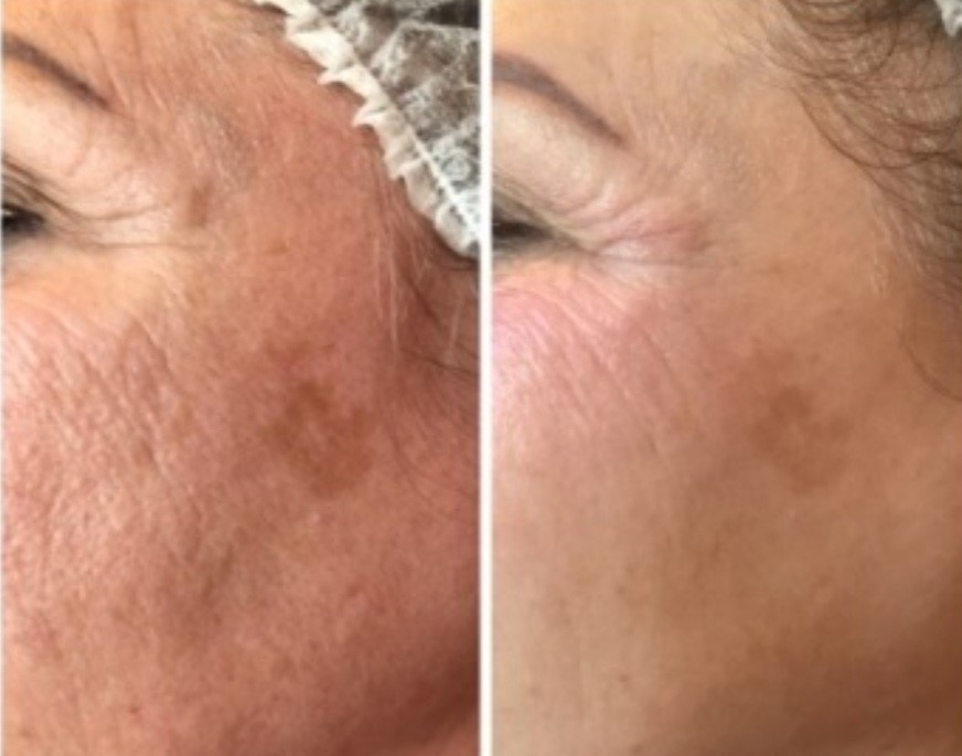 Microneedling